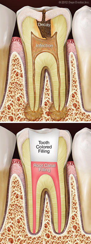 Illustration of before and after root canal treatment