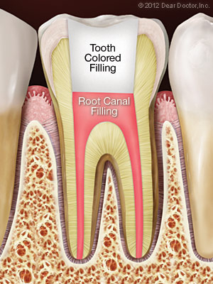 Illustration of what a tooth looks like after root canal