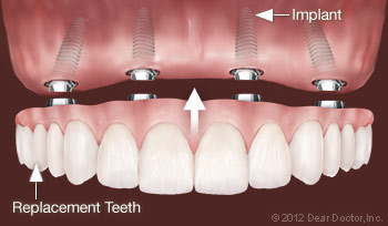 Implant Replacement Teeth