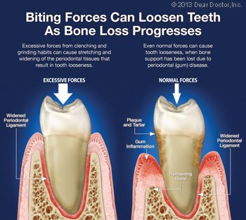 Biting forces can loosen teeth