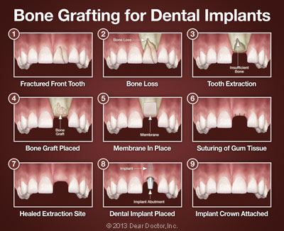 An illustration on bone grafting for dental implants