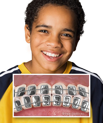 Boy with lingual braces