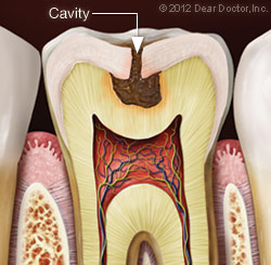 Tooth Cavity Illustration