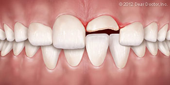 An illustration of a chipped tooth