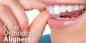 Close Up Shot of a person wearing Clear Orthodontic Aligners