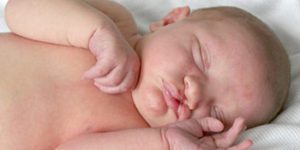 Baby with Cleft lip clept palate sleeping