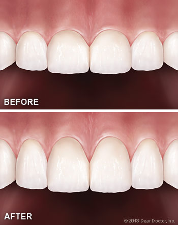 Before and After Cosmetic Gum Surgery CenterCare Dental Group