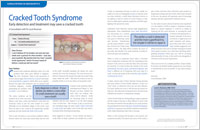 Crack Tooth Syndrome article from Dear Doctor magazine