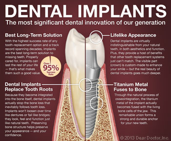 Dental Implants Innovation