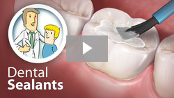 An illustration of dental sealants