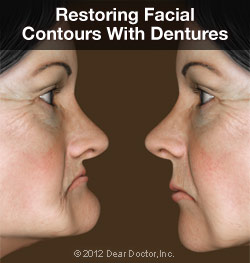 Facial Contours with Dentures Illustration