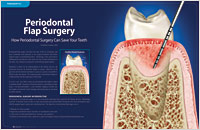 Article on periodontal flap surgery from Dear Doctor magazine