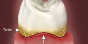 Illustration of inflamed gum disease and tartar