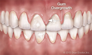 An illustration of gum overgrowth