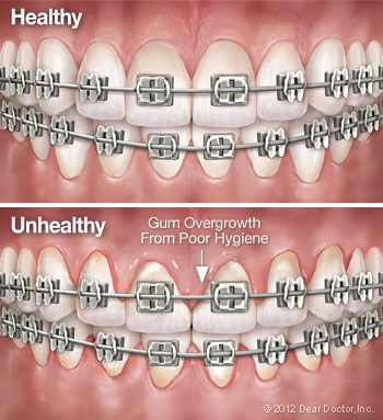 Healthy versus unhealthy teeth