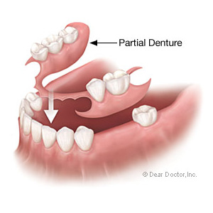 Removable Partial Denture Illustration
