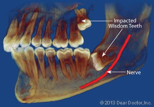 X-ray of an impacted wisdom tooth