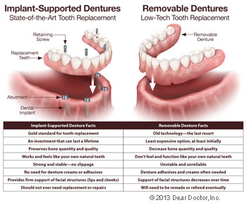 Implant Supported versus Removable Dentures