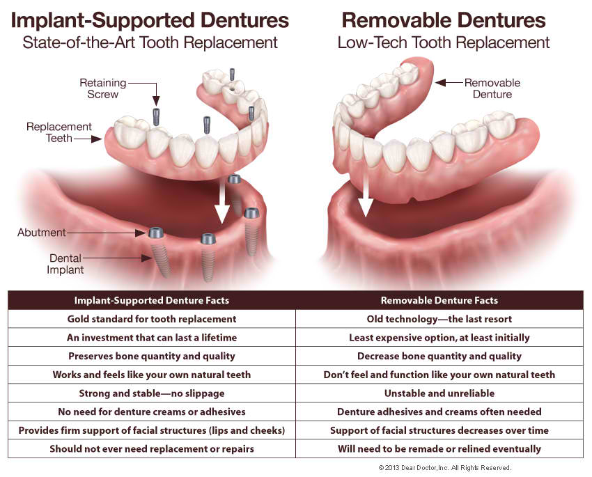 Implant Supported versus Removable Dentures