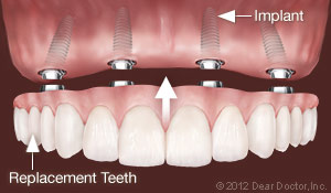 Illustration of dental implant replacing all teeth