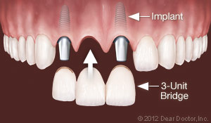 Illustration of dental implant replacing multiple teeth