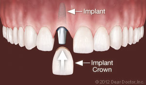 Illustration of dental implant replacing one tooth
