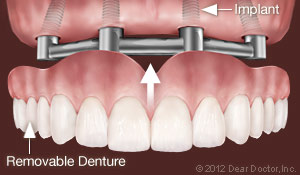 Illustration of dental implant supporting removable dentures