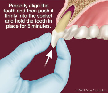 An illustration of knocked out tooth