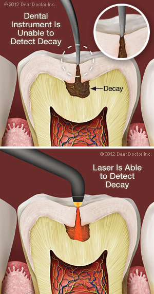 Laser decay diagnosis