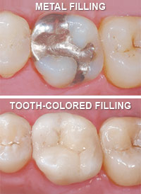 Metal versus tooth colored fillings