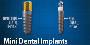 Mini Dental Implants Illustration