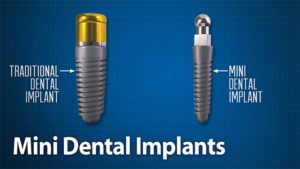 Mini Dental Implants Illustration