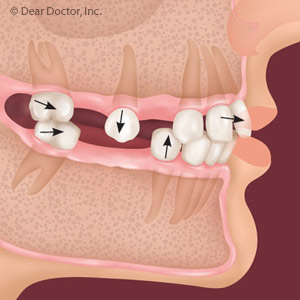 Missing Teeth Implants