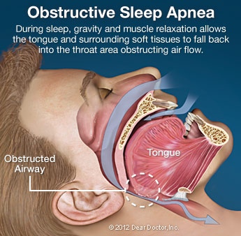 Obstructive Sleep Apnea Illustration