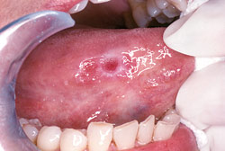 Oral Cancer Symptom through oral cancer screening