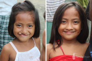 Before and After Operation Photo of a Young Girl with Cleft Lip