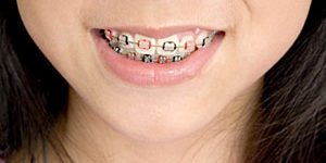 Adolescent girl with braces