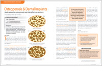 An article on osteoporosis and dental implants from Dear Doctor magazine