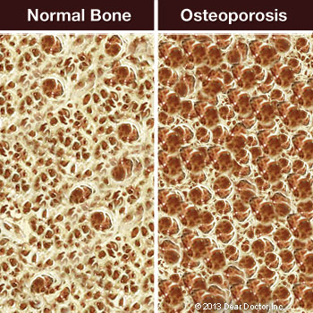An illustration comparing normal bone with one having osteoporosis