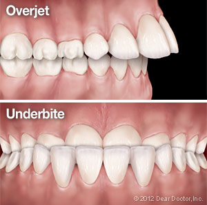 Illustration of overjet and underbit teeth