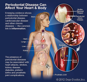 Periodontal Disease and Impact on Heart and Body