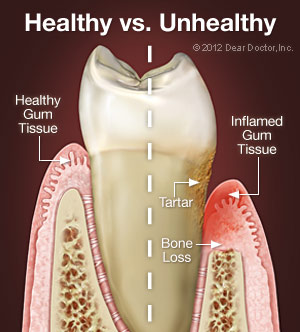 Healthy versus Unhealthy Tooth