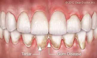 Tartar and Gum Disease Illustration
