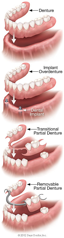 Types of Removable Dentures
