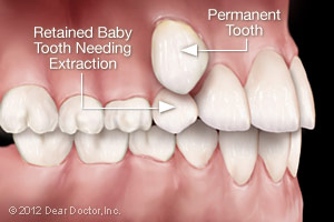Illustration of retained baby tooth