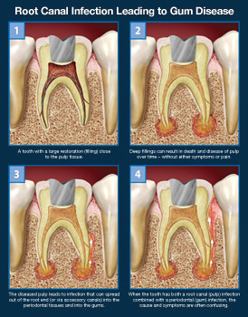 An illustration of root canal infection that led to gum disease