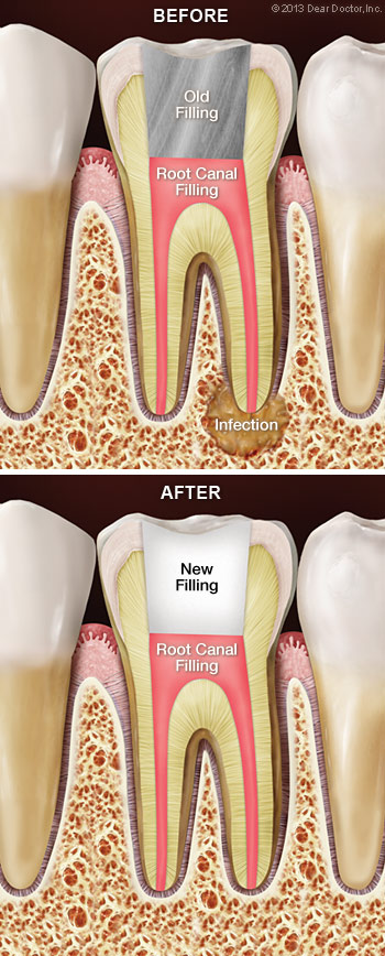 An illustration of before and after root canal retreatment