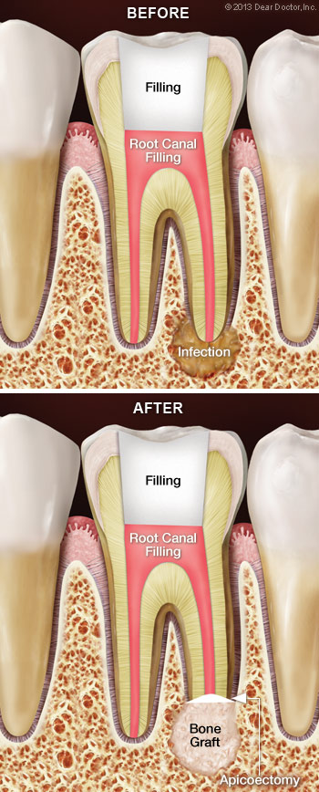 Root Canal Surgery (Apicoectomy) Illustration
