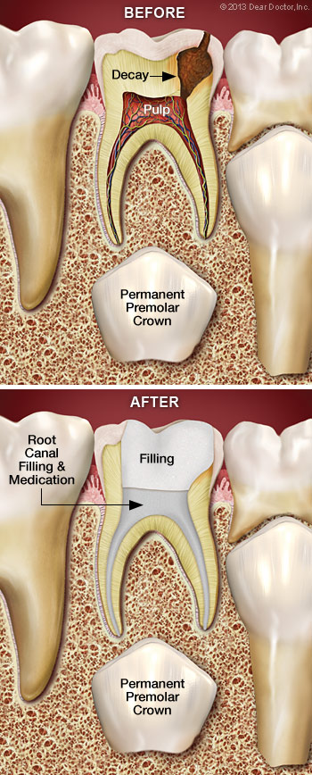 Illustration of Before and After Root Canal Treatment in Children