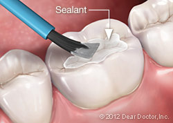 Dental Sealant Application Illustration